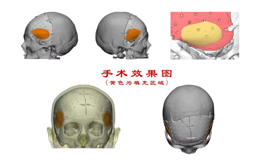 林志穎車禍致顏面骨折，醫(yī)生：或可用3D打印建模進(jìn)行術(shù)后修復(fù)