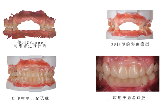 3Shape彩色工作流程，讓牙齒假體越來越“真”！